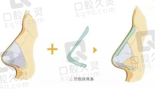 厦门薇格医疗美容林伟亮做鼻子怎么样？林氏原生鼻微创取肋创口小疤痕隐蔽