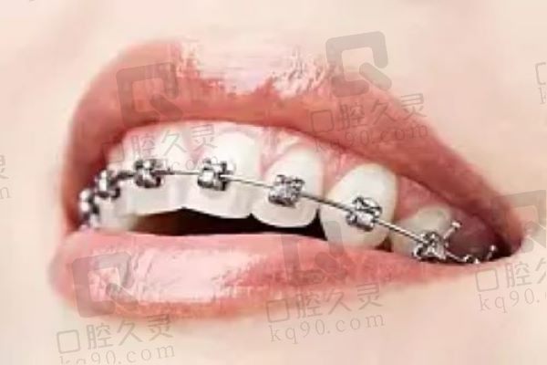 深圳市慈恩口腔时代天使矫正 28000 + 起/,杨林医生亲诊:实例丰富+方案定制化