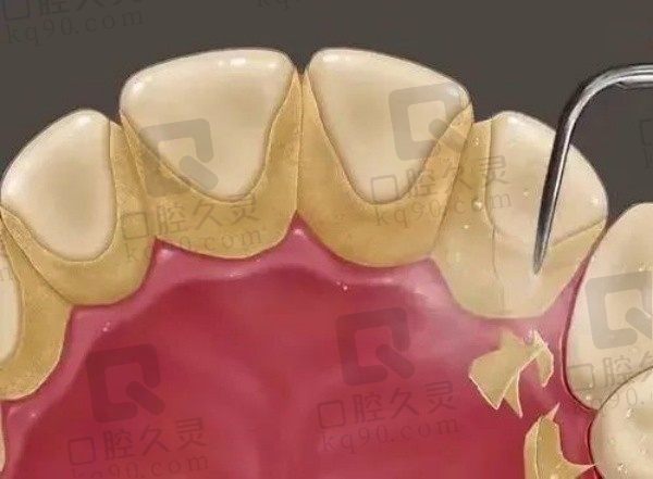 青岛牙博士洗牙54元起，超声波洁牙价格实惠有效预防蛀牙/牙周病
