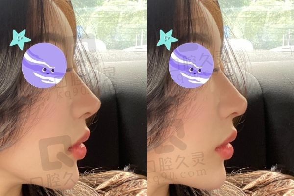 北京沃尔美鼻怎么样？北京沃尔做鼻子技术超强成功案例多价格表合理