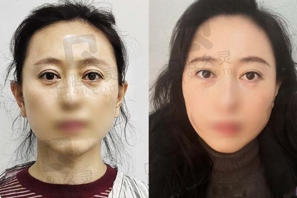 宋桂霞眼睛修复多少钱一次？2025年价格表埋线双眼皮1.2w+全切双眼皮2w+