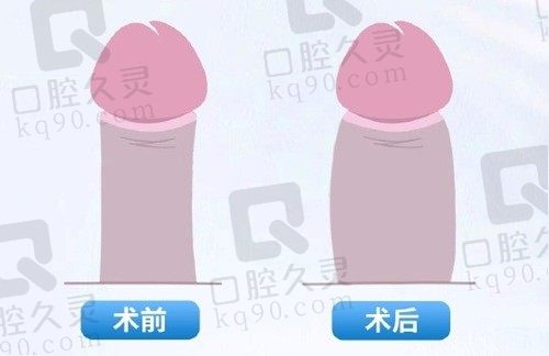 生物补片增粗手术多少钱？2-6万元，对身体无害效果维时间是永久性的