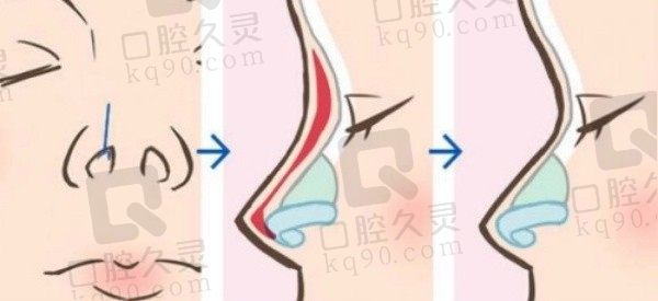 成都游晓波医生鼻修复价格: 3-5.5w起，风格自然技术在线口碑评价高