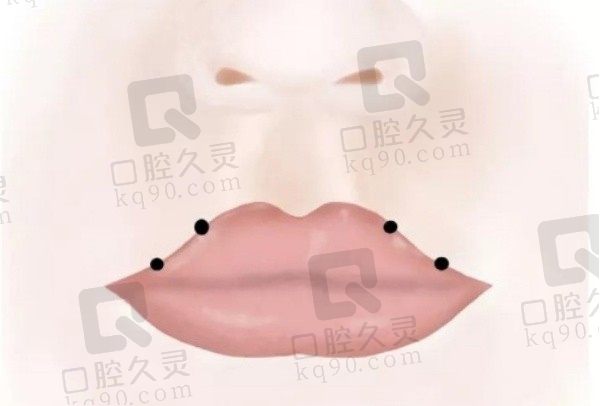 卢九宁人中三件套做的超好，价格15800元起术后不留疤口碑评价高