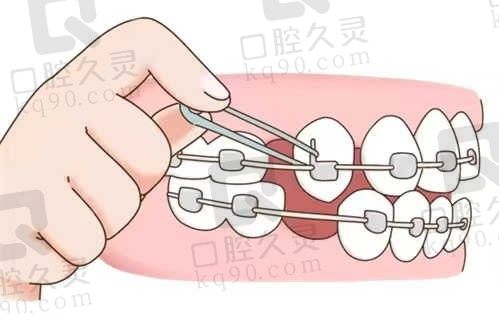 杭州艺星口腔医院怎么样?李伟医生种植牙技术好评价高