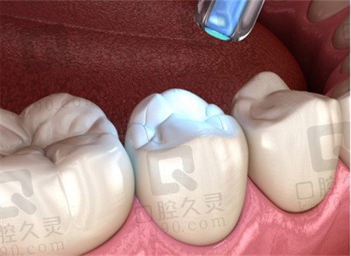 分享我在柳州华心口腔门诊部的补牙经历，这家医院真不错