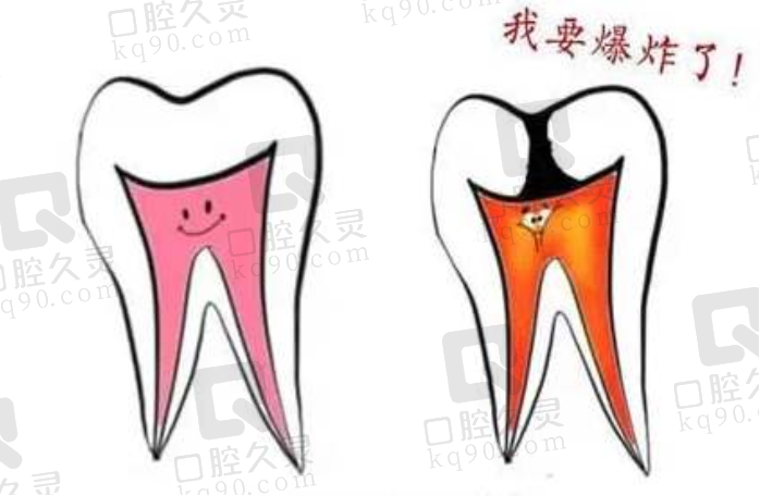 牙髓炎是什么，应该怎么预防呢？