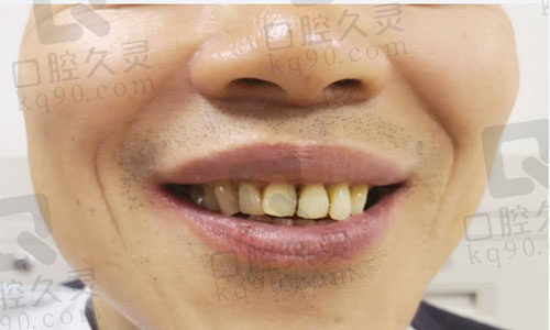 分享我在天津中诺找赵振宇医生做的“立得用”即刻种植牙经历