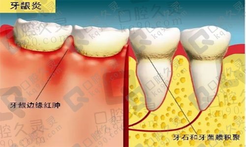 牙龈炎是什么？有哪些症状呢？