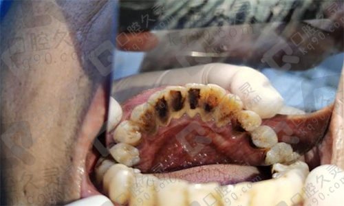 通过重庆成佳牙博士口腔洁牙案例，了解下深度洗牙和普通洗牙的区别