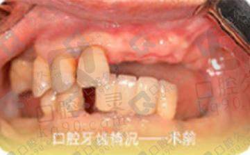 分享杭州亮贝美口腔郭庆医生给妈妈做的即刻种植牙过程