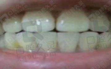 在苏州美奥口腔做了牙齿冷光美白，牙齿白了三个色号