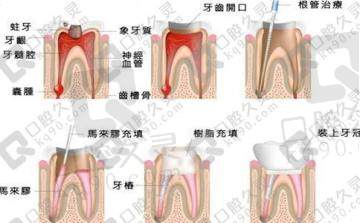 整理成都地区根管治疗做的好的牙科医院，内附价格表
