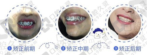 分享同学在深圳格伦菲尔口腔医院做牙齿矫正后的效果，内附价格表！