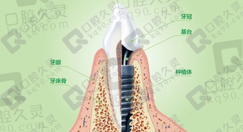 分享北京钛植口腔医院患者做全口种植牙后的效果，种植一颗牙仅需3680元！