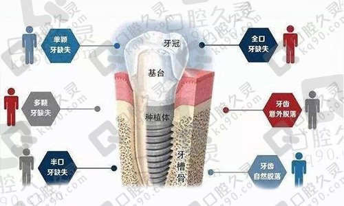 5万块钱能种植全口牙吗？揭秘全口种植牙费用多少钱？