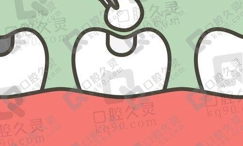 补牙一般用什么材料好？