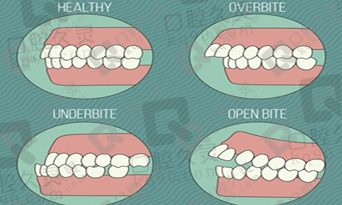 怎样判断牙齿咬合是否正常？牙医分享上下牙咬合错位怎么办