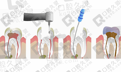 根管治疗后牙齿的寿命大概是多少年？做完根管治疗后注意事项