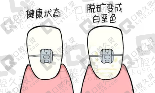 牙齿脱矿如何补救？