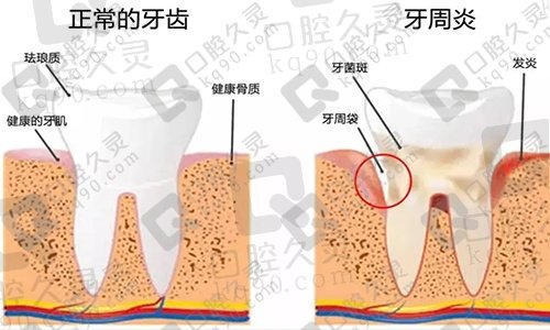 如何区分牙龈炎和牙周炎？