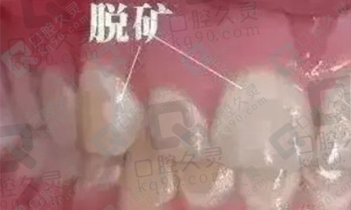 牙齿脱矿什么原因造成的？如何进行补救？