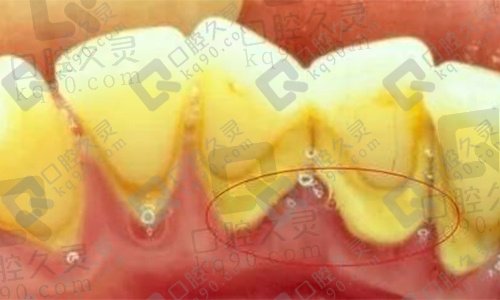 牙结石用什么牙膏去除？有没有自己在家清理牙结石的方法？