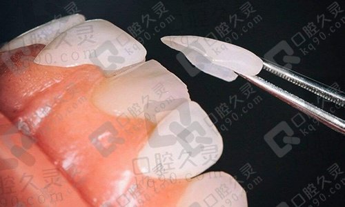 超薄贴面的优点