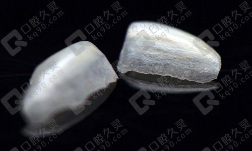 美加超薄贴面
