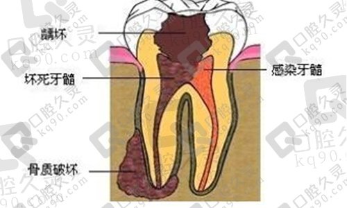 得了根尖周炎一定要做根管治疗吗？不治疗会有什么后果？