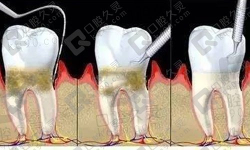 龈下刮治能治好牙周炎吗？想做龈下刮治费用多少啊？