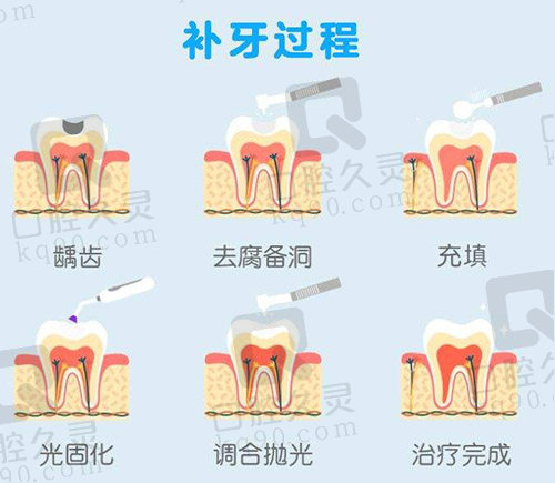 补牙过程