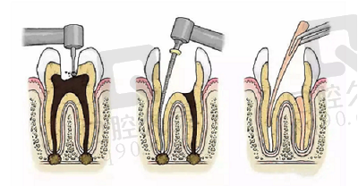 根管治疗方法
