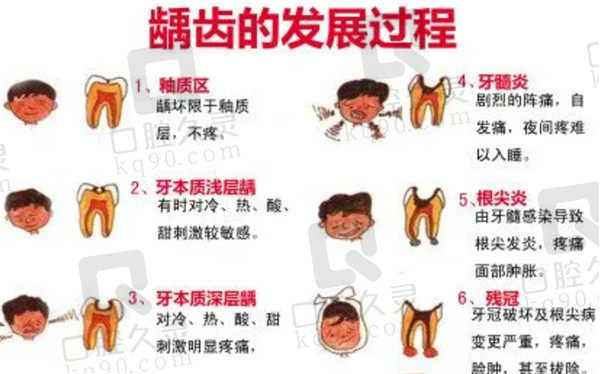 龋齿反展过程