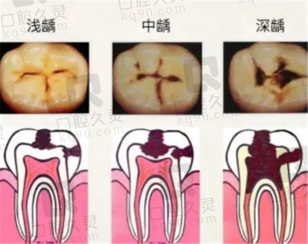 龋齿种类