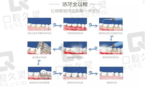 洁牙的过程