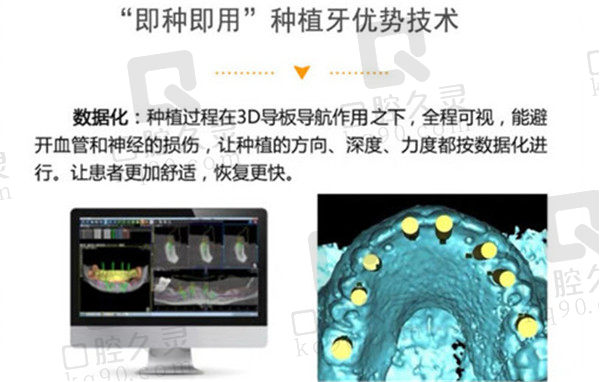 即刻种植牙优势