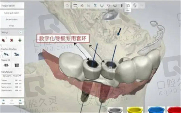 3D导板数字化种植技术优势