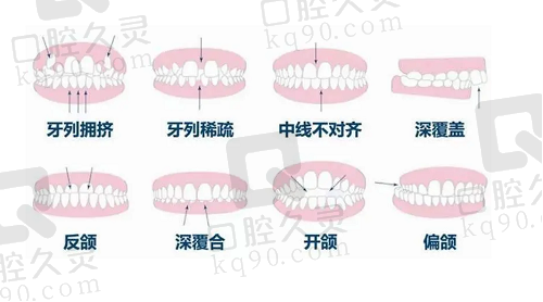 不同类型的牙齿畸形