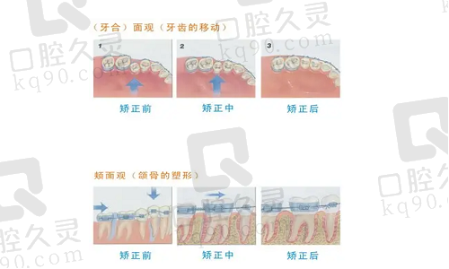 牙齿矫正过程