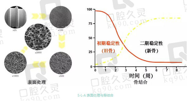 国产百康特种植体稳定性