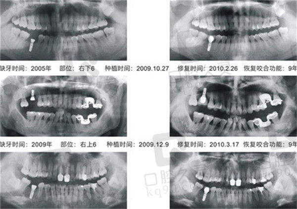 ZDI种植体临床验证数据