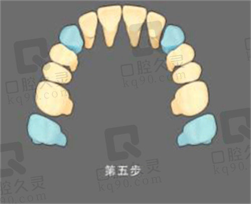 张栋梁ZC牙齿排齐法