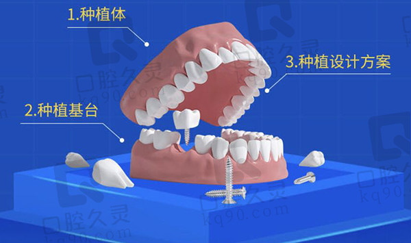 种植牙套餐