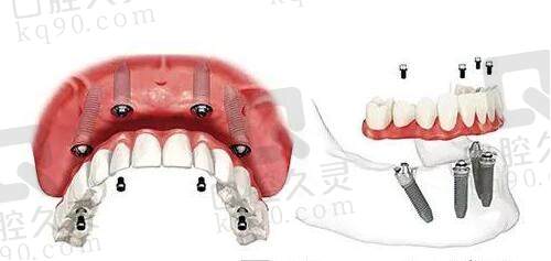 北京马泷齿科all-on-4种植技术