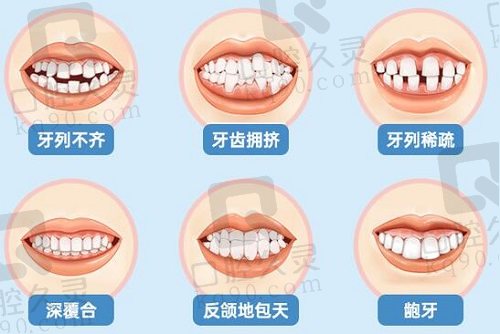 牙齿矫正的适应情况