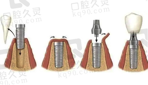 牙齿种植步骤过程图解