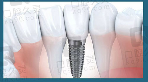 广州中家医家庭医生口腔美国皓圣种植牙