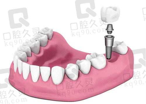 北京钛植口腔种植牙示意图
