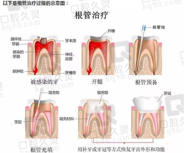 根管治疗过程